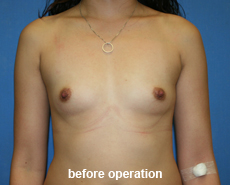 plastic-surgery-breast-augmentation